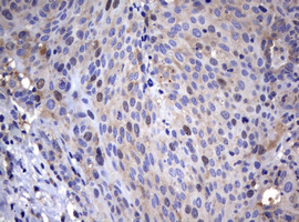 IHC of paraffin-embedded Carcinoma of Human lung tissue using anti-WNT3 mouse monoclonal antibody.