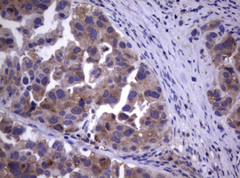 IHC of paraffin-embedded Carcinoma of Human bladder tissue using anti-WNT3 mouse monoclonal antibody. (Heat-induced epitope retrieval by 10mM citric buffer, pH6.0, 120°C for 3min).
