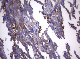 IHC of paraffin-embedded Adenocarcinoma of Human endometrium tissue using anti-WNT3 mouse monoclonal antibody. (Heat-induced epitope retrieval by 10mM citric buffer, pH6.0, 120°C for 3min).