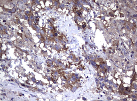 IHC of paraffin-embedded Adenocarcinoma of Human ovary tissue using anti-WNT3 mouse monoclonal antibody. (Heat-induced epitope retrieval by 10mM citric buffer, pH6.0, 120°C for 3min).