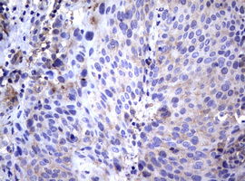 IHC of paraffin-embedded Carcinoma of Human lung tissue using anti-WNT3 mouse monoclonal antibody. (Heat-induced epitope retrieval by 10mM citric buffer, pH6.0, 120°C for 3min).