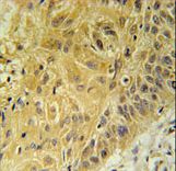 WNT5A Antibody immunohistochemistry of formalin-fixed and paraffin-embedded human lung carcinoma followed by peroxidase-conjugated secondary antibody and DAB staining.