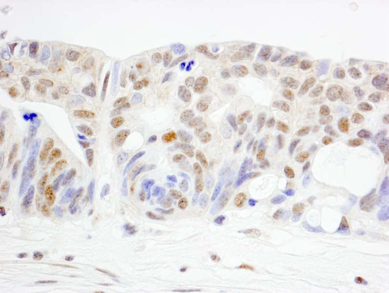 Detection of Human WRNIP1 by Immunohistochemistry. Sample: FFPE section of human ovarian carcinoma. Antibody: Affinity purified rabbit anti-WRNIP1 used at a dilution of 1:1000 (1 ug/ml). Detection: DAB.