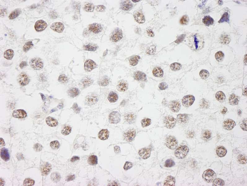 Detection of Human WTAP by Immunohistochemistry. Sample: FFPE section of human testicular seminoma. Antibody: Affinity purified rabbit anti-WTAP used at a dilution of 1:1000 (1 ug/ml). Detection: DAB.