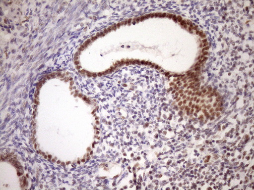IHC of paraffin-embedded Carcinoma of Human pancreas tissue using anti-WTAP mouse monoclonal antibody. (Heat-induced epitope retrieval by Tris-EDTA, pH8.0)(1:150).