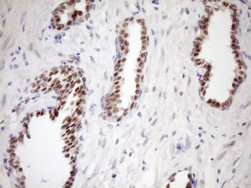 IHC of paraffin-embedded Carcinoma of Human prostate tissue using anti-WTAP mouse monoclonal antibody. (Heat-induced epitope retrieval by Tris-EDTA, pH8.0)(1:150).