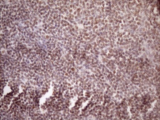 IHC of paraffin-embedded Human lymphoma tissue using anti-WTAP mouse monoclonal antibody. (Heat-induced epitope retrieval by Tris-EDTA, pH8.0)(1:150).