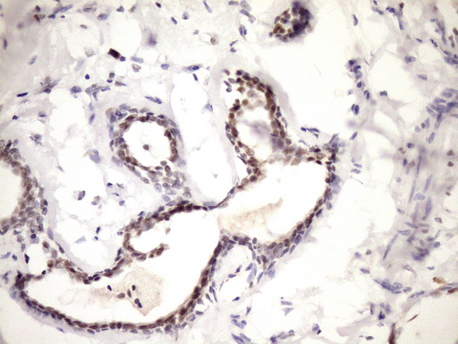 IHC of paraffin-embedded Human breast tissue using anti-WTAP mouse monoclonal antibody. (Heat-induced epitope retrieval by Tris-EDTA, pH8.0)(1:150).