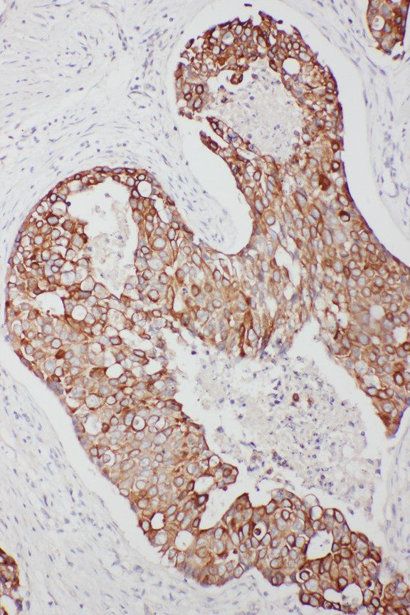 TNFAIP8L3 antibody. IHC(P): Human Breast Cancer Tissue.