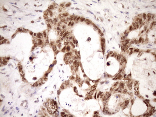 IHC of paraffin-embedded Adenocarcinoma of Human colon tissue using anti-WTAP mouse monoclonal antibody. (Heat-induced epitope retrieval by Tris-EDTA, pH8.0)(1:150).