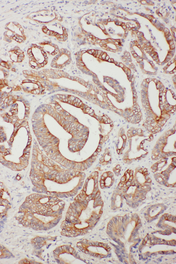 TNFAIP8L3 antibody. IHC(P): Human Intestinal Cancer Tissue.