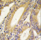 Formalin-fixed and paraffin-embedded human colon carcinoma tissue reacted with BIRC4 antibody , which was peroxidase-conjugated to the secondary antibody, followed by DAB staining. This data demonstrates the use of this antibody for immunohistochemistry; clinical relevance has not been evaluated.