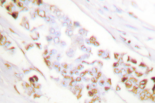 IHC of XRCC1 (G552) pAb in paraffin-embedded human lung carcinoma tissue.