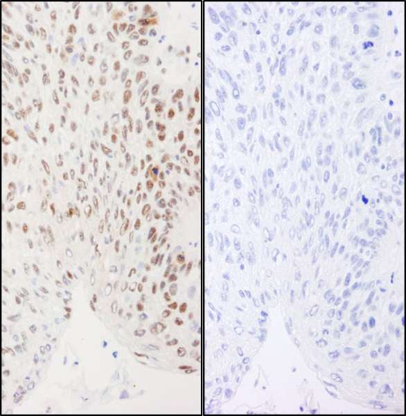 Detection of Human Phospho XRCC1 (S461) by Immunohistochemistry. Samples: FFPE serial sections of human larynx squamous cell carcinoma. Mock phosphatase treated section (left) and calf intestinal phosphatase-treated section (right). Antibody: Affinity purified rabbit anti-Phospho XRCC1 (S461). used at a dilution of 1:1000 (1 ug/ml. Detection: DAB.