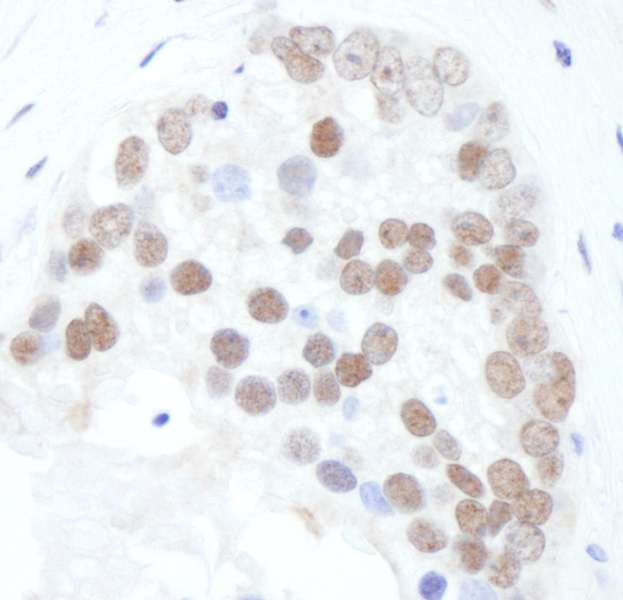 Detection of Human Phospho-ERCC1 (S518/T519/T523) by Immunohistochemistry. Sample: FFPE section of human prostate carcinoma. Antibody: Affinity purified rabbit anti-Phospho-XRCC1 (S518/T519/T523) used at a dilution of 1:5000 (0.2 Detection: DAB.