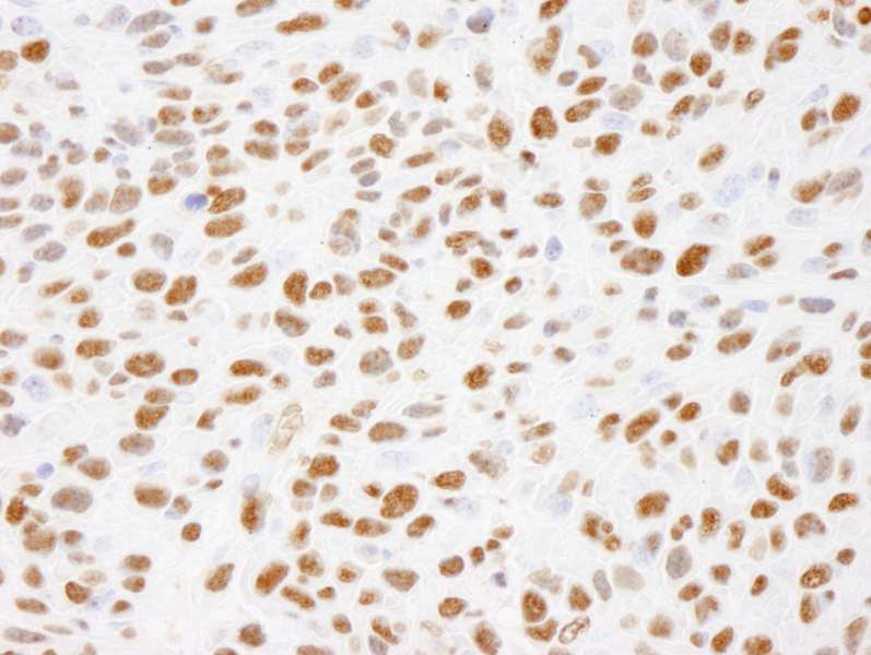 Detection of Mouse Phospho XRCC1 (S485/T488) by Immunohistochemistry. Sample: FFPE section of mouse squamous cell carcinoma. Antibody: Affinity purified rabbit anti-Phospho XRCC1 (S485/T488). used at a dilution of 1:250.