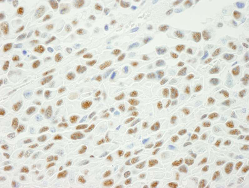 Detection of Mouse Phospho XRCC1 (S461) by Immunohistochemistry. Sample: FFPE section of mouse squamous cell carcinoma. Antibody: Affinity purified rabbit anti-Phospho XRCC1 (S461). used at a dilution of 1:250.