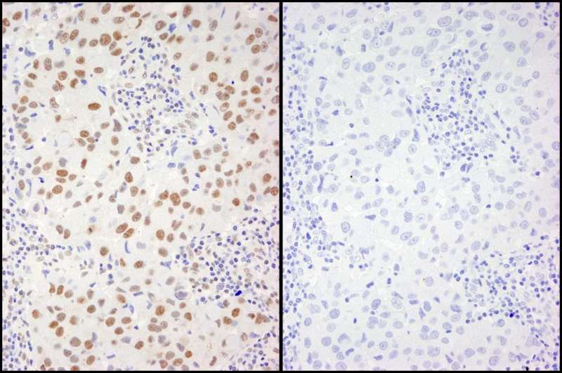 Detection of Human Phospho XRCC1 (S461) by Immunohistochemistry. Samples: FFPE serial sections of human breast adenocarcinoma. Mock phosphatase treated section (left) or calf intestinal phosphatase-treated section (right) immunostained for Phospho XRCC1 (S461). Antibody: Affinity purified rabbit anti-Phospho XRCC1 (S461). used at a dilution of 1:250.