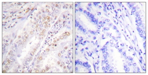 IHC of paraffin-embedded human lung carcinoma, using XRCC2 Antibody. The picture on the right is treated with the synthesized peptide.