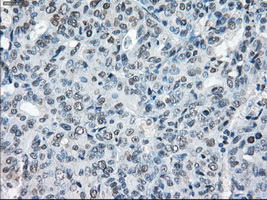 IHC of paraffin-embedded Adenocarcinoma of endometrium tissue using anti-XRCC4 mouse monoclonal antibody. (Dilution 1:50).
