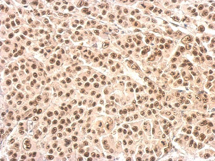 XRCC4 antibody detects XRCC4 protein at nucleus on HBL435 xenograft by immunohistochemical analysis. Sample: Paraffin-embedded HBL435 xenograft. XRCC4 antibody dilution:1:500.