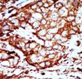 Formalin-fixed and paraffin-embedded human cancer tissue reacted with the primary antibody, which was peroxidase-conjugated to the secondary antibody, followed by AEC staining. This data demonstrates the use of this antibody for immunohistochemistry; clinical relevance has not been evaluated. BC = breast carcinoma; HC = hepatocarcinoma.