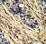 Formalin-fixed and paraffin-embedded human colon carcinoma reacted with YWHAG Antibody , which was peroxidase-conjugated to the secondary antibody, followed by DAB staining. This data demonstrates the use of this antibody for immunohistochemistry; clinical relevance has not been evaluated.
