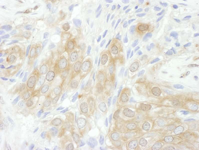 Detection of Human 14-3-3-theta by Immunohistochemistry. Sample: FFPE section of human breast carcinoma. Antibody: Affinity purified rabbit anti-14-3-3-theta used at a dilution of 1:5000 (0.2 ug/ml). Detection: DAB.