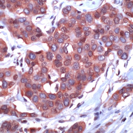 Human breast ca. stained with Anti-14-3-3 zeta