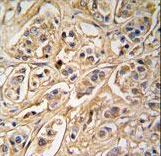 Formalin-fixed and paraffin-embedded human breast carcinoma tissue reacted with 14-3-3 protein zeta/delta antibody , which was peroxidase-conjugated to the secondary antibody, followed by DAB staining. This data demonstrates the use of this antibody for immunohistochemistry; clinical relevance has not been evaluated.