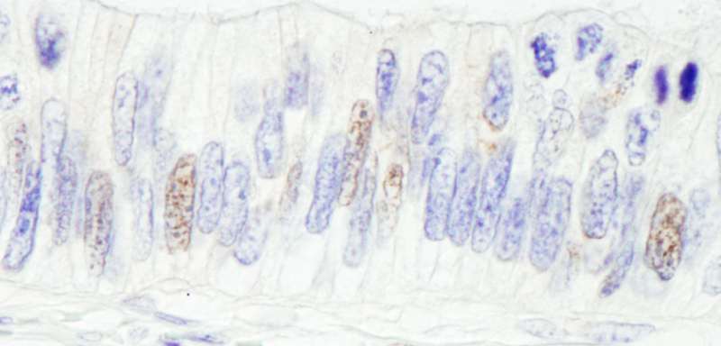 Detection of Human ZC3H13 by Immunohistochemistry. Sample: FFPE section of human colon carcinoma. Antibody: Affinity purified rabbit anti-ZC3H13 used at a dilution of 1:1000 (1 ug/ml). Detection: DAB.