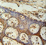 ZC3H3 Antibody immunohistochemistry of formalin-fixed and paraffin-embedded human skin carcinoma followed by peroxidase-conjugated secondary antibody and DAB staining.