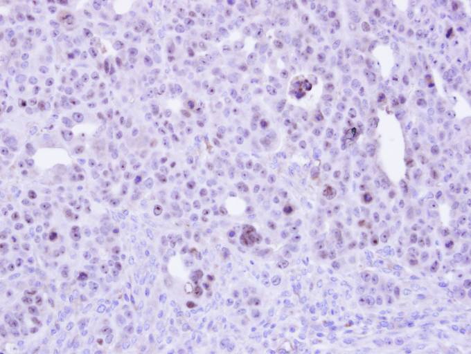 IHC of paraffin-embedded NCIN87 xenograft using ZC3H8 antibody at 1:500 dilution.