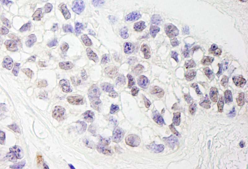 Detection of Human ZEB1 by Immunohistochemistry. Sample: FFPE section of human breast carcinoma. Antibody: Affinity purified rabbit anti-ZEB1 used at a dilution of 1:1000 (0.2 ug/ml). Detection: DAB.