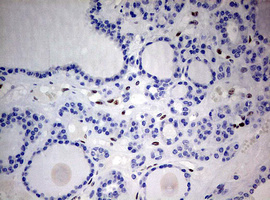 IHC of paraffin-embedded Carcinoma of Human thyroid tissue using anti-ZEB1 mouse monoclonal antibody. (Heat-induced epitope retrieval by 10mM citric buffer, pH6.0, 120°C for 3min).