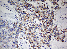 IHC of paraffin-embedded Carcinoma of Human pancreas tissue using anti-ZEB1 mouse monoclonal antibody. (Heat-induced epitope retrieval by 10mM citric buffer, pH6.0, 120°C for 3min).