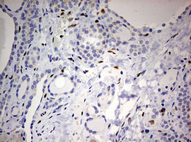 IHC of paraffin-embedded Human thyroid tissue using anti-ZEB1 mouse monoclonal antibody. (Heat-induced epitope retrieval by 10mM citric buffer, pH6.0, 120°C for 3min).
