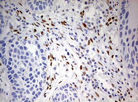 IHC of paraffin-embedded Carcinoma of Human lung tissue using anti-ZEB1 mouse monoclonal antibody. (Heat-induced epitope retrieval by 10mM citric buffer, pH6.0, 120°C for 3min).