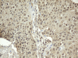 IHC of paraffin-embedded Carcinoma of Human lung tissue using anti-ZFAND5 mouse monoclonal antibody.