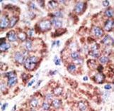 Formalin-fixed and paraffin-embedded human cancer tissue reacted with the primary antibody, which was peroxidase-conjugated to the secondary antibody, followed by AEC staining. This data demonstrates the use of this antibody for immunohistochemistry; clinical relevance has not been evaluated. BC = breast carcinoma; HC = hepatocarcinoma.