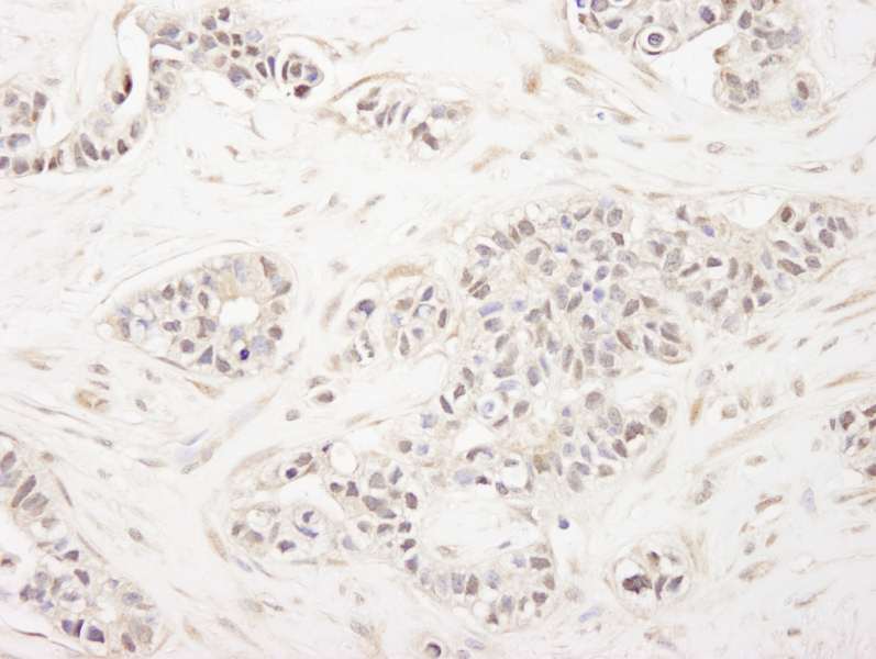 Detection of Human FOG1/ZFPM1 by Immunohistochemistry. Sample: FFPE section of human breast carcinoma. Antibody: Affinity purified rabbit anti-FOG1/ZFPM1 used at a dilution of 1:250.
