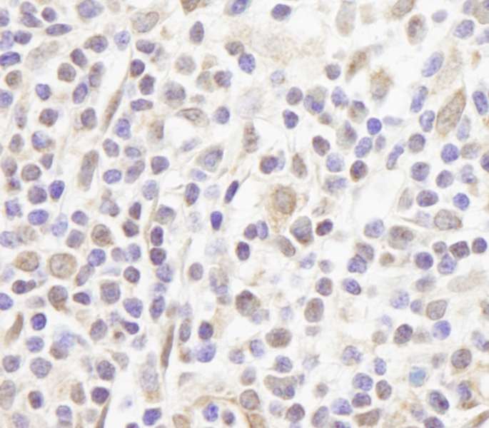 Detection of Human FOG1/ZFPM1 by Immunohistochemistry. Sample: FFPE section of human Hodgkin's Lymphoma. Antibody: Affinity purified rabbit anti-FOG1/ZFPM1 used at a dilution of 1:250.