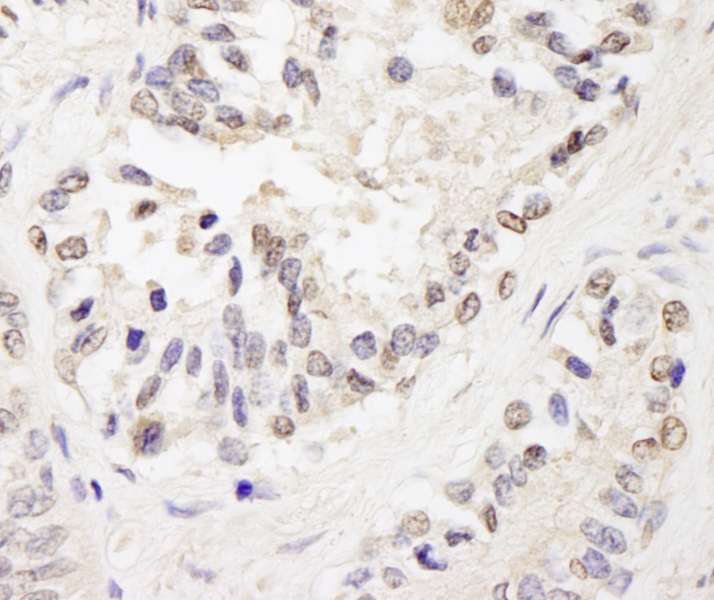 Detection of Human FOG1/ZFPM1 by Immunohistochemistry. Sample: FFPE section of human prostate carcinoma. Antibody: Affinity purified rabbit anti-FOG1/ZFPM1 used at a dilution of 1:200 (1 ug/ml). Detection: DAB.