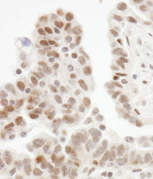 Detection of Human ZHX1 by Immunohistochemistry. Sample: FFPE section of human ovarian carcinoma. Antibody: Affinity purified rabbit anti-ZHX1 used at a dilution of 1:1000 (1 ug/ml). Detection: DAB.