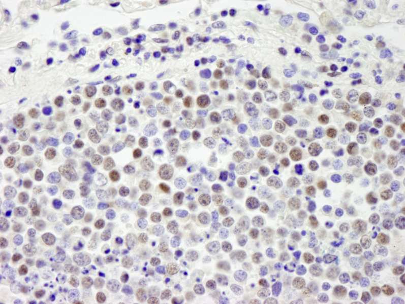 Detection of Human ZHX1 by Immunohistochemistry. Sample: FFPE section of human small cell lung cancer. Antibody: Affinity purified rabbit anti-ZHX1 used at a dilution of 1:250.