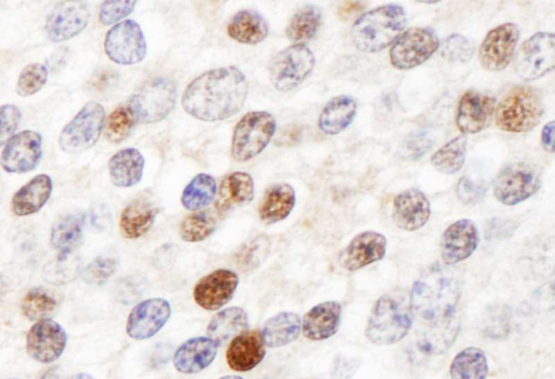 Detection of Human ZHX3 by Immunohistochemistry. Sample: FFPE section of human prostate carcinoma. Antibody: Affinity purified rabbit anti-ZHX3 used at a dilution of 1:1000 (1 ug/ml). Detection: DAB.
