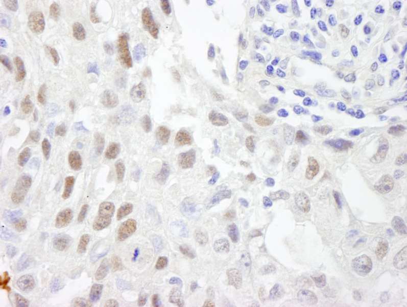 Detection of Human ZHX3 by Immunohistochemistry. Sample: FFPE section of human breast carcinoma. Antibody: Affinity purified rabbit anti-ZHX3 used at a dilution of 1:500.