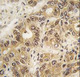 Formalin-fixed and paraffin-embedded human hepatocarcinoma tissue reacted with ZIC3 antibody , which was peroxidase-conjugated to the secondary antibody, followed by DAB staining. This data demonstrates the use of this antibody for immunohistochemistry; clinical relevance has not been evaluated.