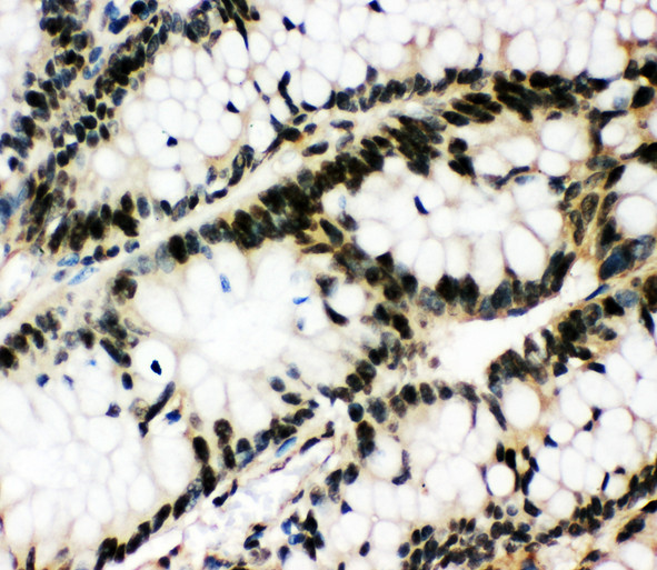 ZIF268 / EGR1 antibody. IHC(P): Human Intestinal Cancer Tissue.