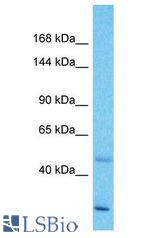 ZNF138 antibody Western Blot of Esophagus Tumor. Antibody dilution: 1 ug/ml.
